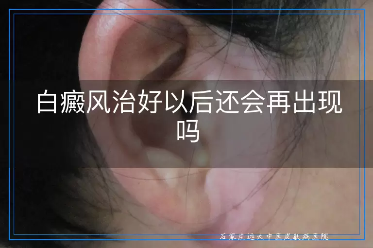 白癜风治好以后还会再出现吗