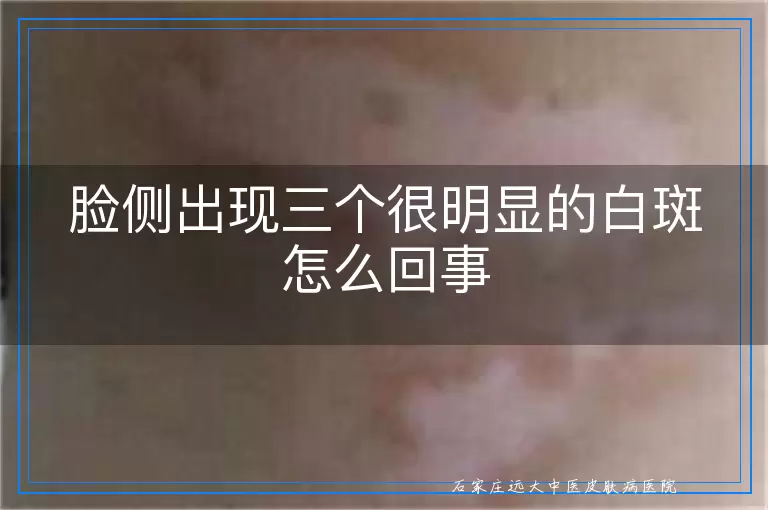 脸侧出现三个很明显的白斑怎么回事