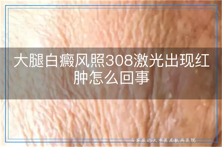 大腿白癜风照308激光出现红肿怎么回事