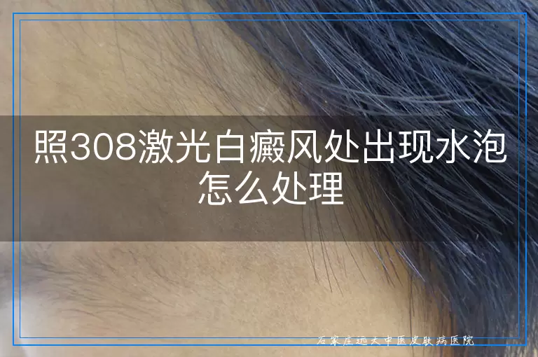 照308激光白癜风处出现水泡怎么处理