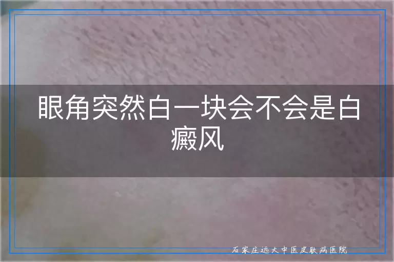 眼角突然白一块会不会是白癜风