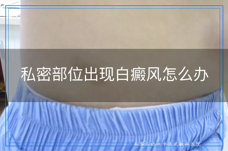 私密部位出现白癜风怎么办