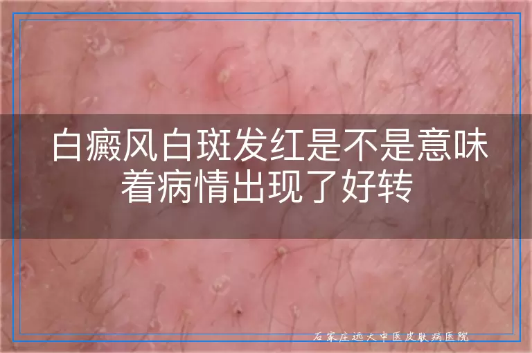 白癜风白斑发红是不是意味着病情出现了好转
