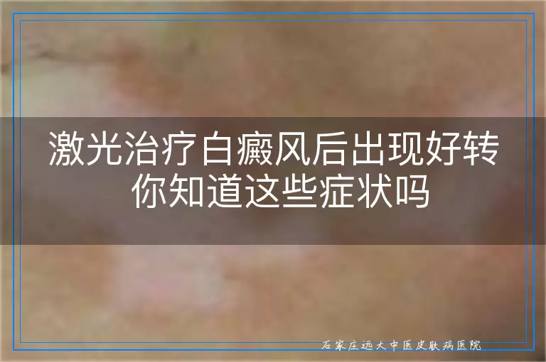 激光治疗白癜风后出现好转 你知道这些症状吗