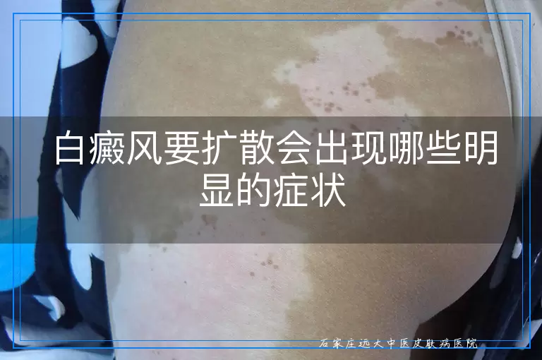 白癜风要扩散会出现哪些明显的症状