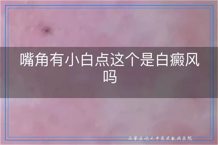 嘴角有小白点这个是白癜风吗