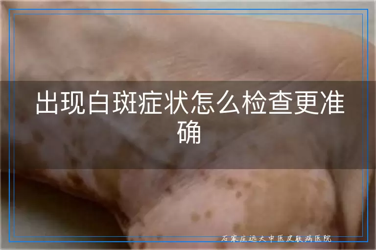 出现白斑症状怎么检查更准确