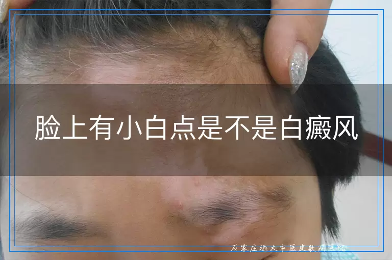 脸上有小白点是不是白癜风