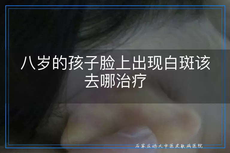 八岁的孩子脸上出现白斑该去哪治疗