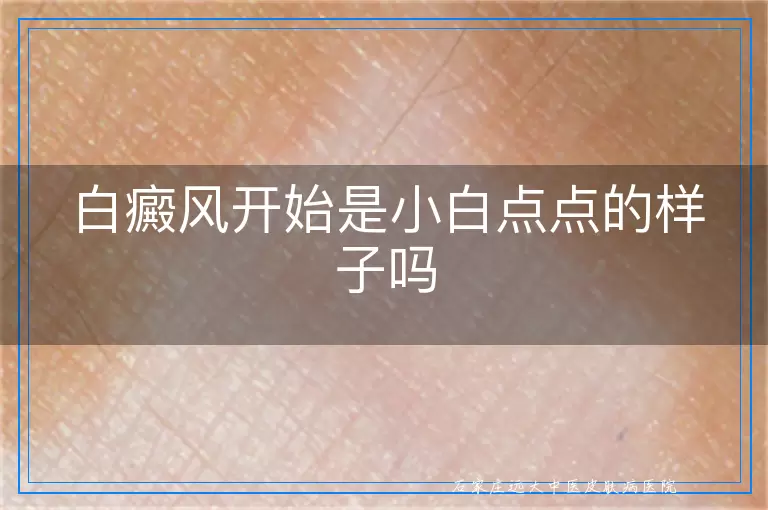 白癜风开始是小白点点的样子吗