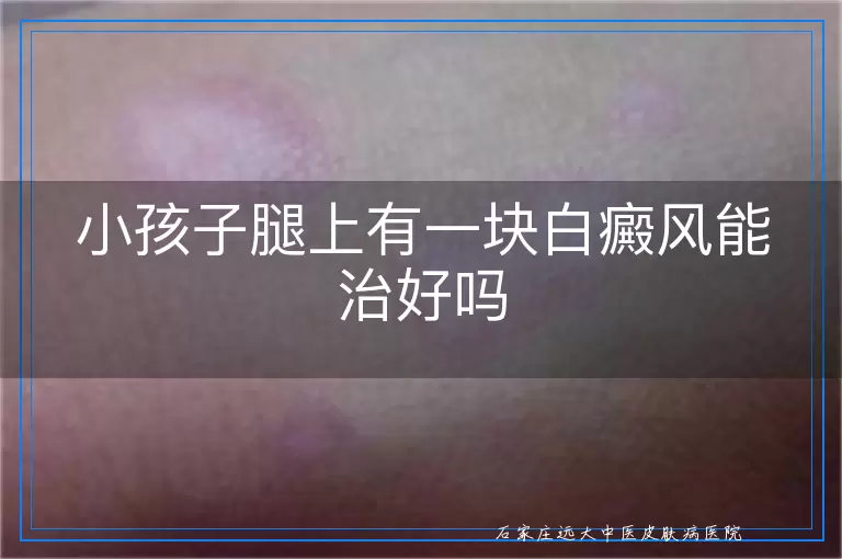 小孩子腿上有一块白癜风能治好吗