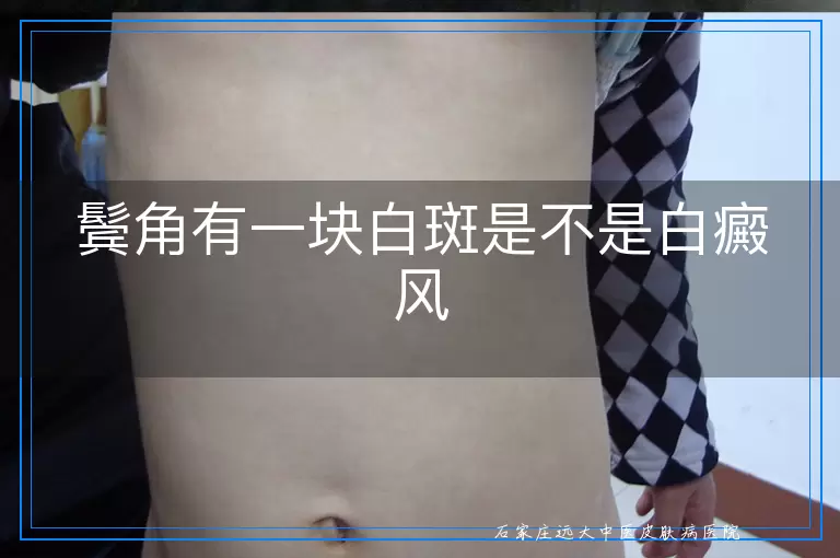 鬓角有一块白斑是不是白癜风