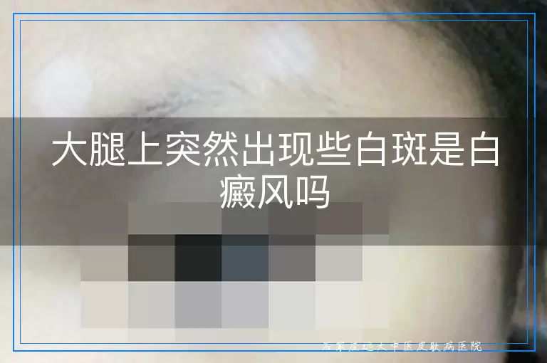大腿上突然出现些白斑是白癜风吗