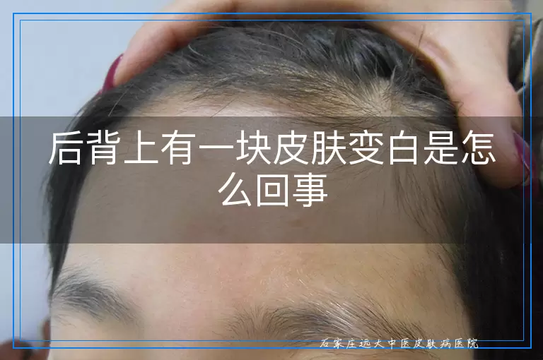 后背上有一块皮肤变白是怎么回事