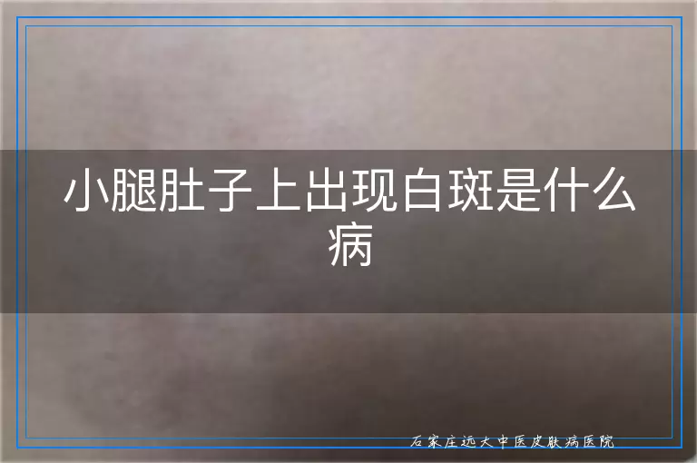 小腿肚子上出现白斑是什么病