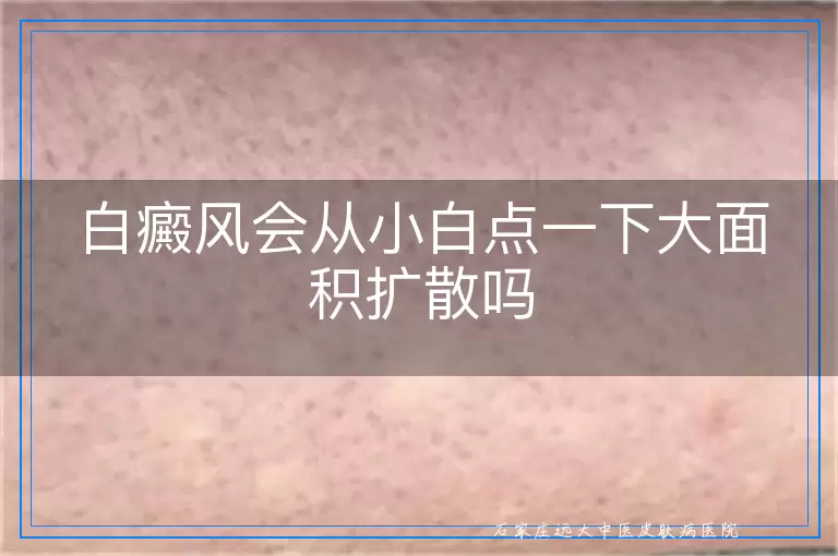 白癜风会从小白点一下大面积扩散吗