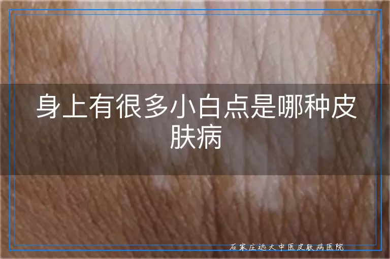 身上有很多小白点是哪种皮肤病