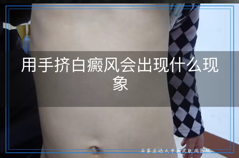 用手挤白癜风会出现什么现象