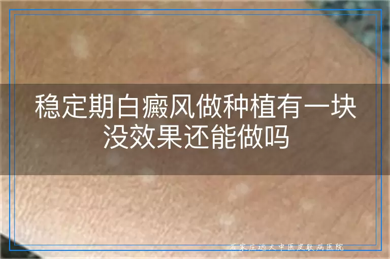 稳定期白癜风做种植有一块没效果还能做吗