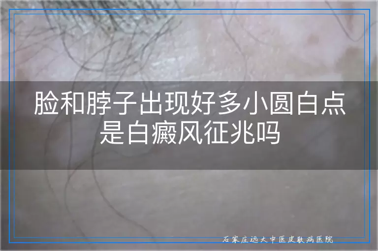 脸和脖子出现好多小圆白点是白癜风征兆吗