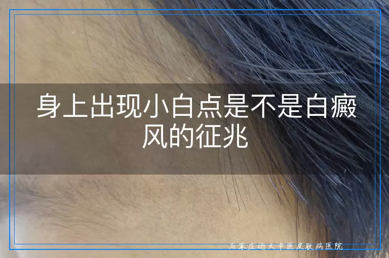 身上出现小白点是不是白癜风的征兆