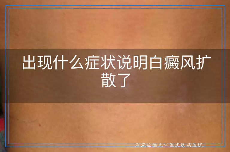 出现什么症状说明白癜风扩散了