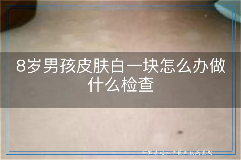 8岁男孩皮肤白一块怎么办做什么检查