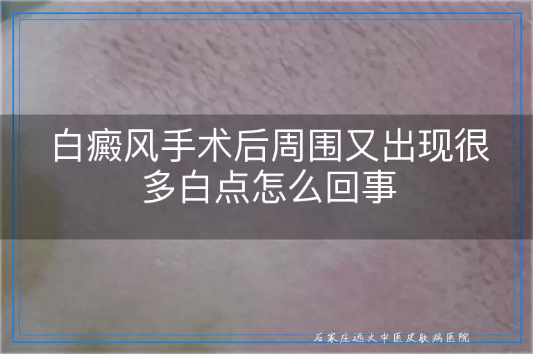 白癜风手术后周围又出现很多白点怎么回事