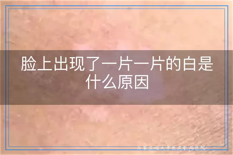 脸上出现了一片一片的白是什么原因