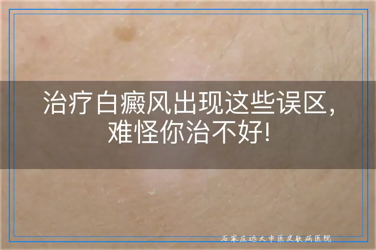 治疗白癜风出现这些误区，难怪你治不好!