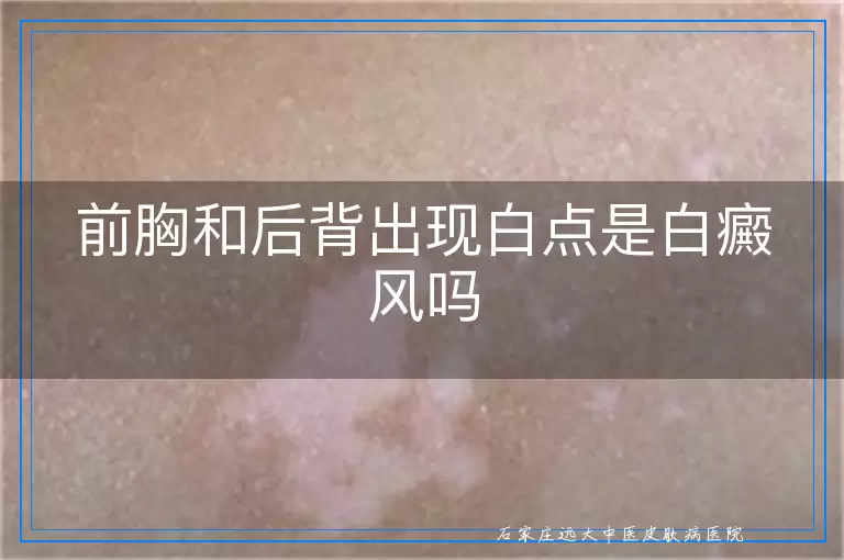 前胸和后背出现白点是白癜风吗