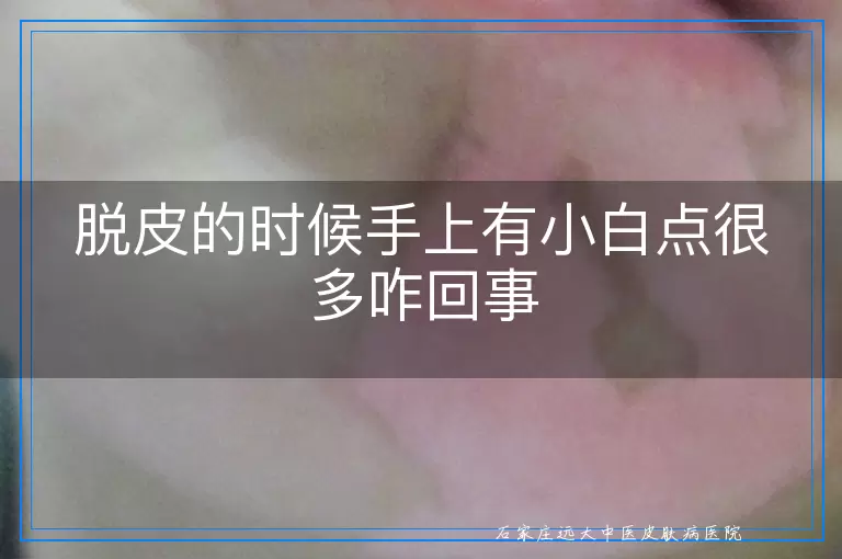 脱皮的时候手上有小白点很多咋回事
