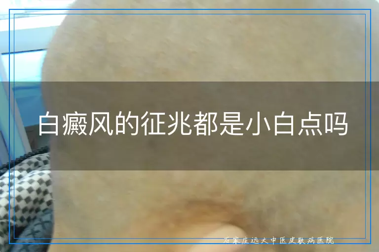 白癜风的征兆都是小白点吗