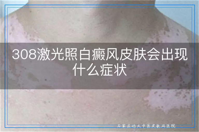 308激光照白癜风皮肤会出现什么症状
