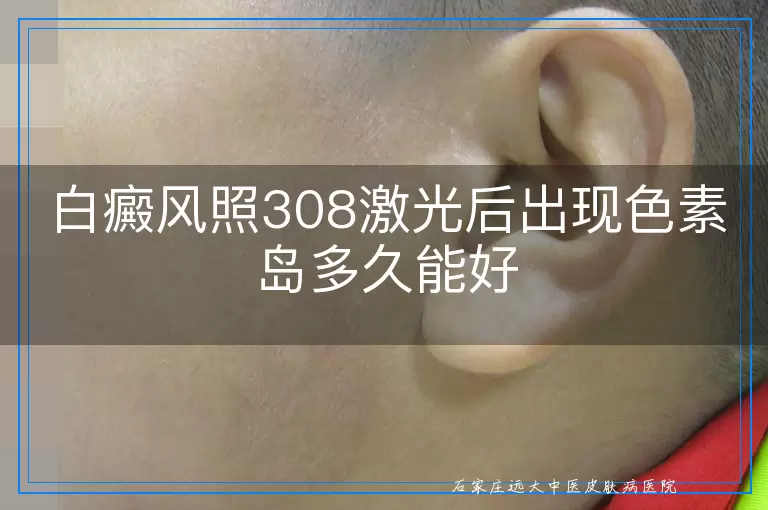 白癜风照308激光后出现色素岛多久能好
