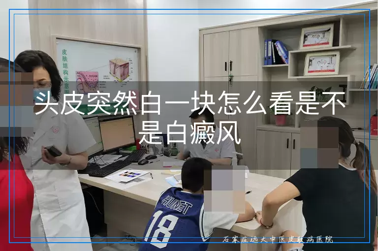 头皮突然白一块怎么看是不是白癜风