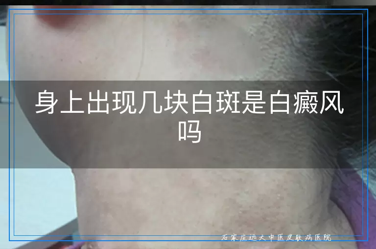 身上出现几块白斑是白癜风吗