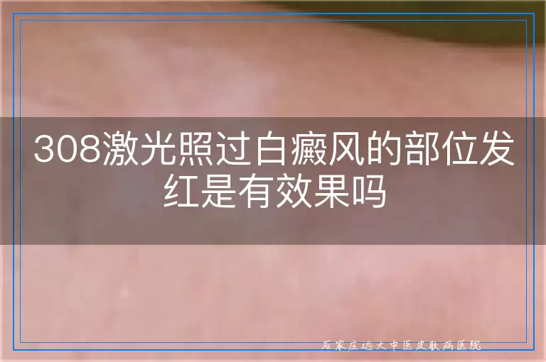 308激光照过白癜风的部位发红是有效果吗