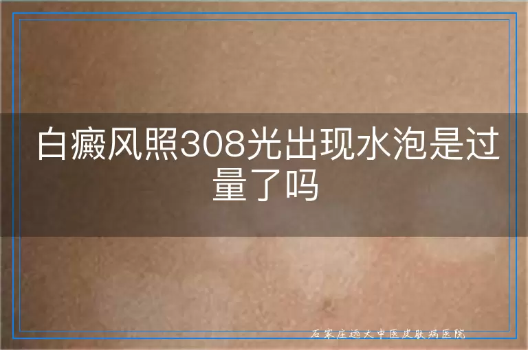 白癜风照308光出现水泡是过量了吗