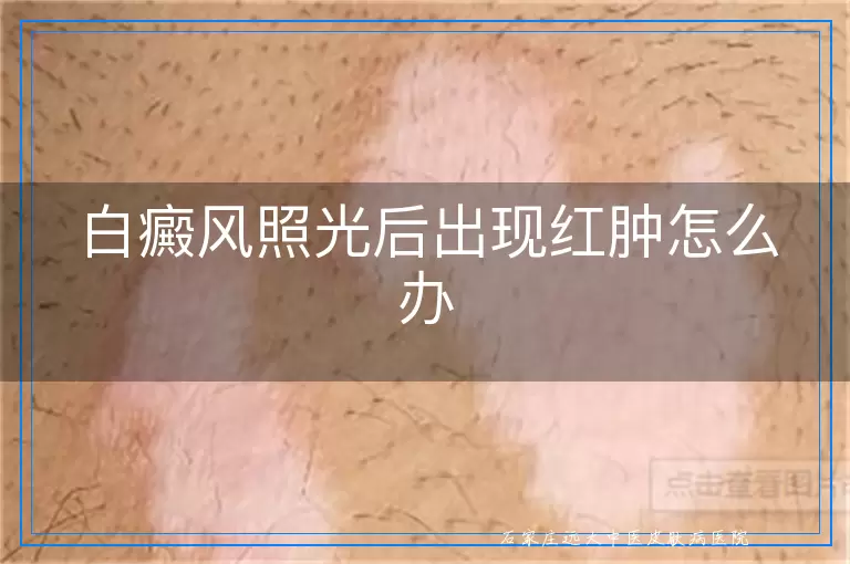 白癜风照光后出现红肿怎么办