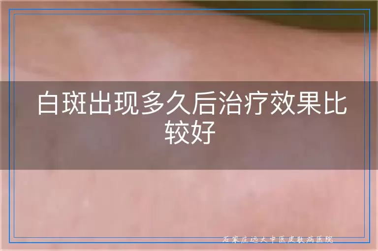 白斑出现多久后治疗效果比较好