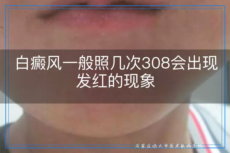 白癜风一般照几次308会出现发红的现象