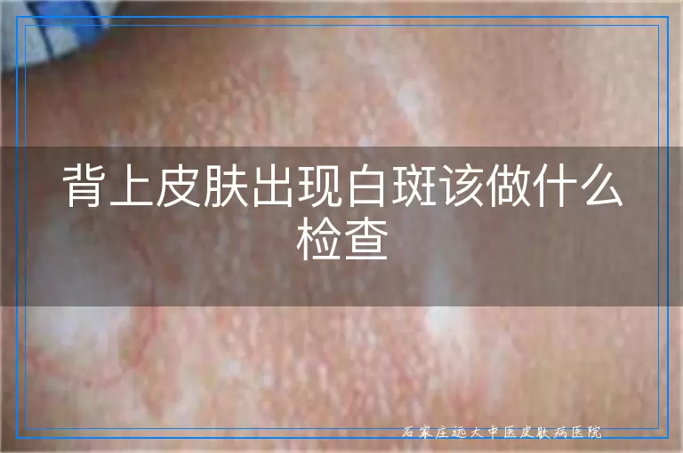 背上皮肤出现白斑该做什么检查