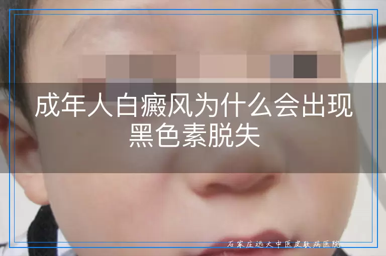成年人白癜风为什么会出现黑色素脱失