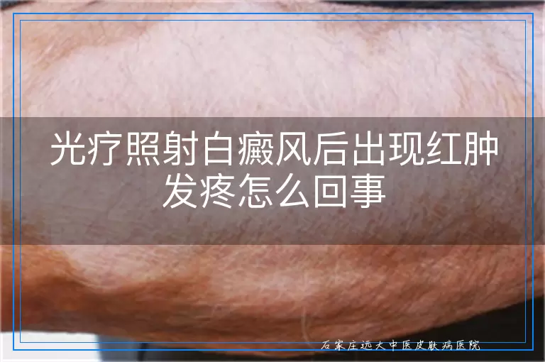 光疗照射白癜风后出现红肿发疼怎么回事