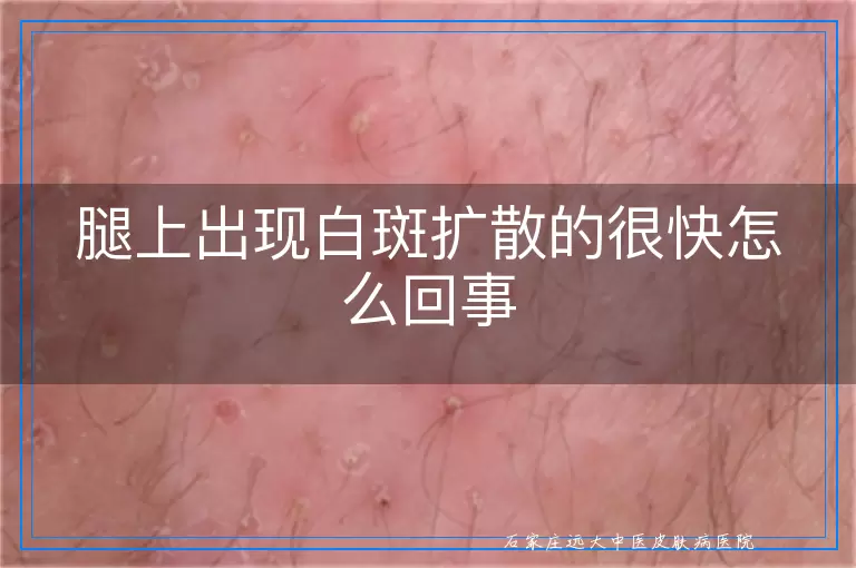 腿上出现白斑扩散的很快怎么回事