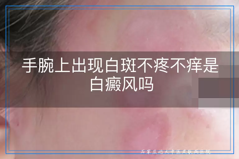 手腕上出现白斑不疼不痒是白癜风吗