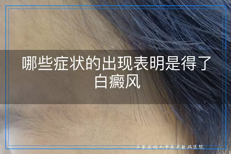 哪些症状的出现表明是得了白癜风