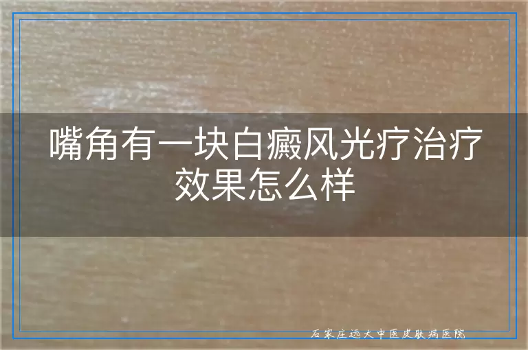 嘴角有一块白癜风光疗治疗效果怎么样