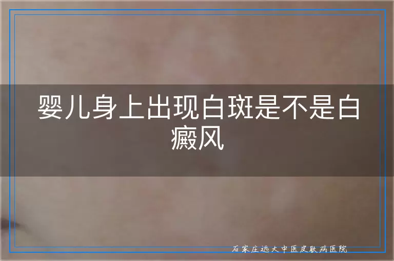 婴儿身上出现白斑是不是白癜风